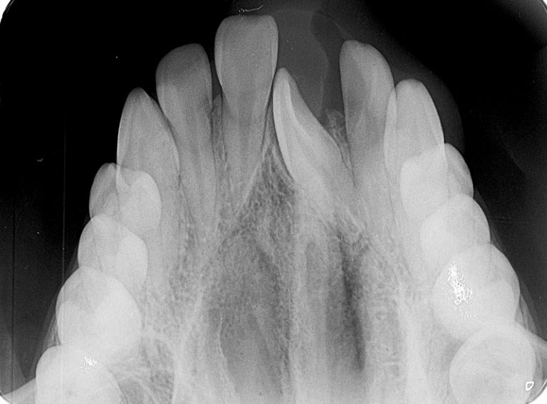 Radiografia Oclusal Dx Diagnostico Dental